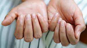 brittle nails